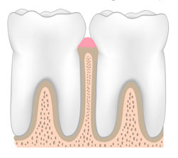 Healthy periodontium