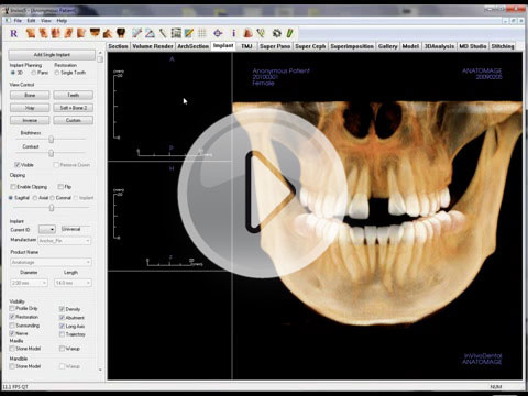 3D Implant Planning with the Invivi5 Software